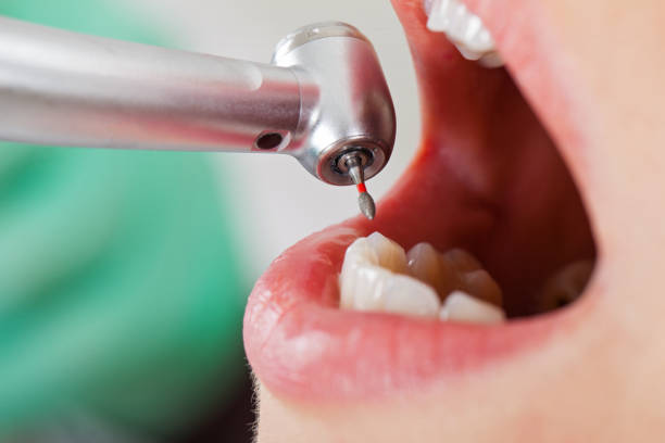 Best Emergency Dental Extractions in Park City, IL